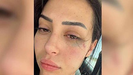 asya-karaali-guney-kibris-ta-dovuldugunu-iddia-ediyor_8f05d